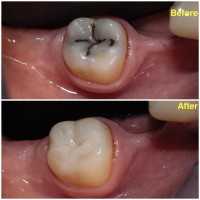 Restaurare estetica realizata in Clinica Dentastic