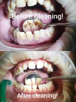 Neculcea Victoria - Profilaxie dentară Neculcea Victoria - Profilaxie dentară