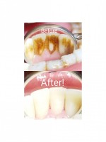 Neculcea Victoria - Profilaxie dentară Neculcea Victoria - Profilaxie dentară