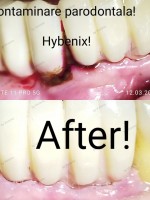 Neculcea Victoria - Profilaxie dentară Neculcea Victoria - Profilaxie dentară