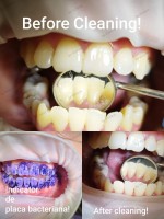 Neculcea Victoria - Profilaxie dentară Neculcea Victoria - Profilaxie dentară