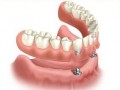 Ce este proteza dentara permanenta?