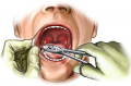 Extractia dentara simpla sau nechirurgicala