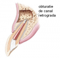 Obturatie de canal retrograda