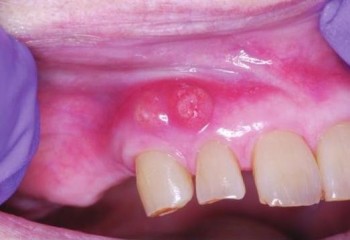 Abcesul periodontal