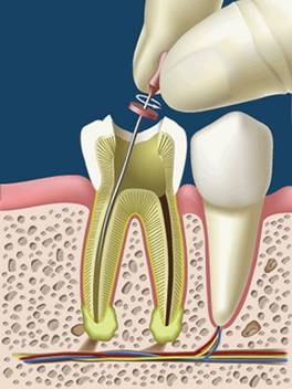 Retratament endodontic