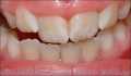 Fluoroza dentara