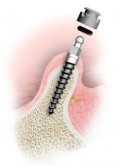 Mini implantul dentar