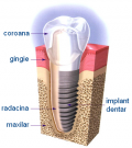Ar fi indicat un implant dentar la mine?