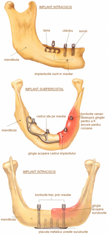 Tipuri de implanturi dentare