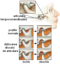 Sindromul articulatiei temporomandibulare