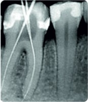   Retroalveolara, periapicala,de detaliu,evidentiaza dintele in intregime