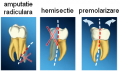 Amputatie radiculara, hemisectie si premolarizare