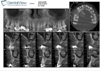 Sectiuni CT maxilar