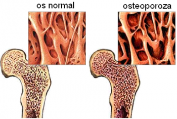 Osteoporoza este un factor de risc in cazul implantelor dentare?