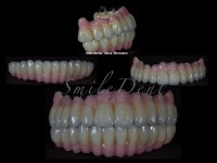 lucrare protetica cu masca gingivala lucrare protetica cu masca gingivala