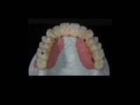 lucrare fixa  pe implante lucrare fixa  pe implante