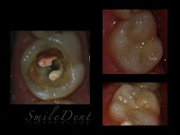 obturatie molar obturatie molar