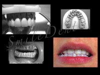 zirconia zirconia