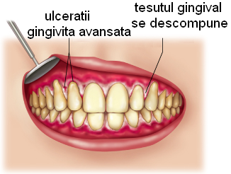 Gingivita acuta ulcero-necrotica