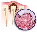 Chisturile si tumorile odontogene