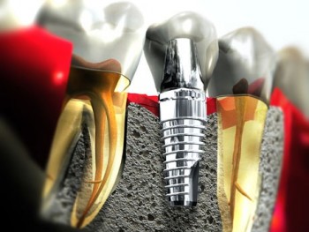 Istoria implantului dentar