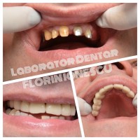 Metalo ceramica + Ivoclar inline Metalo ceramica + Ivoclar inline