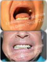 Proteza acrilica Proteza acrilica