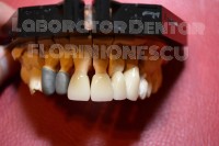 Metalo Ceramica - ivoclar inline Metalo Ceramica - ivoclar inline