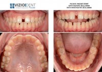 POZE INTRAORALE PENTRU DIAGNOSTIC POZE INTRAORALE PENTRU DIAGNOSTIC