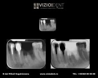 RADIOGRAFIE RETROALEVEOLARA RADIOGRAFIE RETROALEVEOLARA