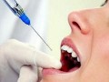 Anestezia dentara
