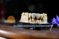 Ceramica presata e.max press Ceramica presata e.max press