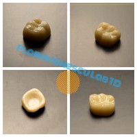 Zirconia + e.max Zirconia + e.max