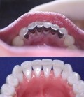 Imobilizare dinti parodontotici