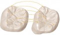 Tratament de echilibrare ocluzala a dintilor parodontotici