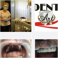 Punte ancorata pe 8 implante dentare