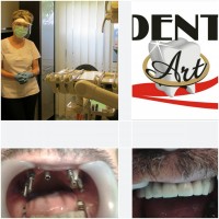 Punte ancorata pe 8 implante dentare Punte ancorata pe 8 implante dentare
