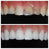 Fatete dentare realizate in Clinica Dentastic