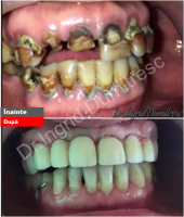 Reabilitarea a fost facuta in limitele financiare ale pacientului. Reabilitarea a fost facuta in limitele financiare ale pacientului.