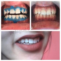 Albire Dentara Profesionala Albire Dentara Profesionala