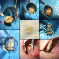 Încrustatie(overlay) din compozit, facuta în laborator. Încrustatie(overlay) din compozit, facuta în laborator.