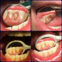 Restaurari directe în aceeasi sedinta. Restaurari directe în aceeasi sedinta.