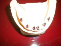 implanturi dentare cu bonturi protetice