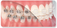 aparat dentar metalic/safir