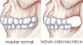 Osteonecroza mandibulara