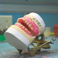 Cat timp rezista protezele dentare?
