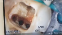 Tratament endodontic la microscop sub izolare cu diga