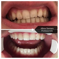 Albire Dentara profesionala Albire Dentara profesionala