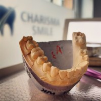 Coroana metalo-ceramica Coroana metalo-ceramica